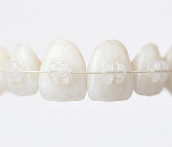 Керамічні самолігуючі брекети в Renessans Dental Clinic